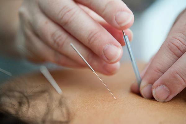 Acupuncture for mnd