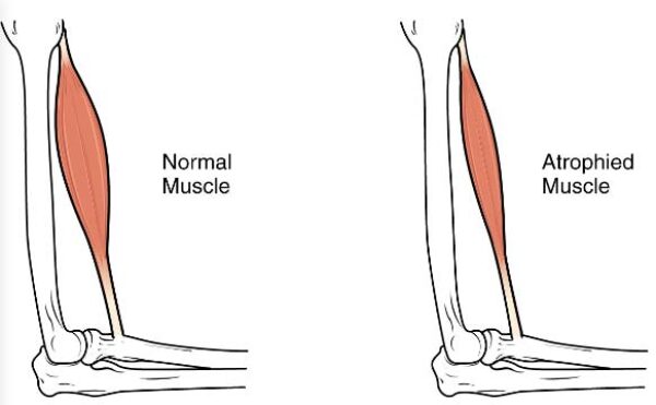 Progressive Muscular Atrophy